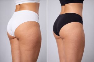 Вакуумный массаж