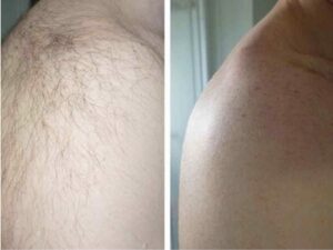 Электроэпиляция